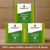 Anti acne soap -100g