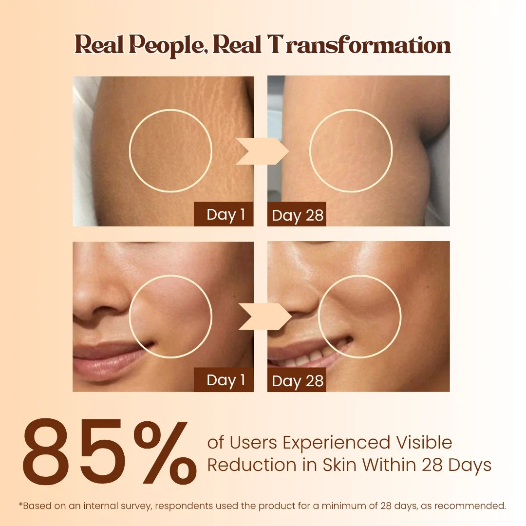 Skin Transition Care Duo | Stretch Mark and Melasma Repair