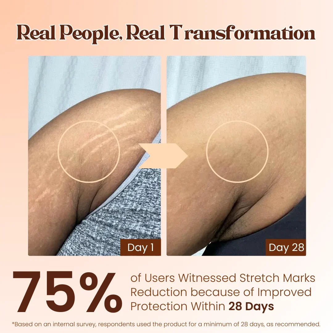 Stretch Mark Roll On