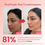 Dark Spot Removal Cream