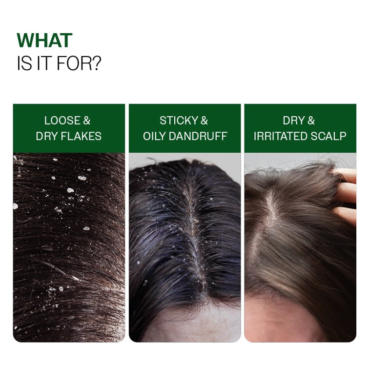 Anti-Dandruff Shampoo (250ml ) & Dandruff Control Spray (200 ml) Combo