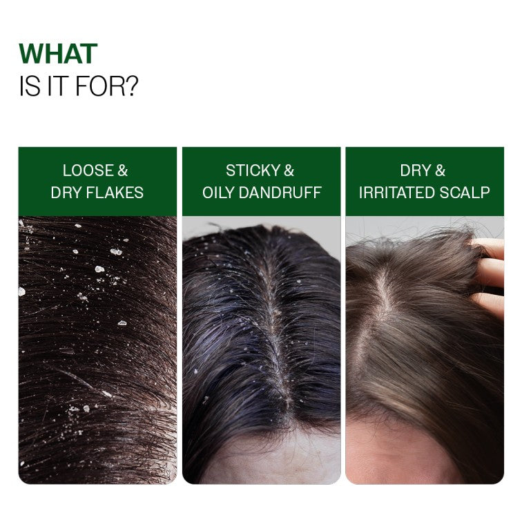 Anti-Dandruff Shampoo (250ml ) & Anti-Dandruff Serum (50 ml) Combo
