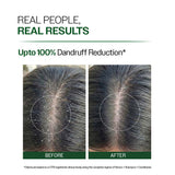 Anti Dandruff Shampoo With Salicylic Acid, Piroctone Olamine & Biotin - 250 ml