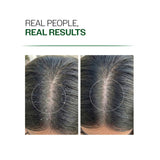 Anti-Dandruff Shampoo (250ml ) & Dandruff Control Spray (200 ml) Combo