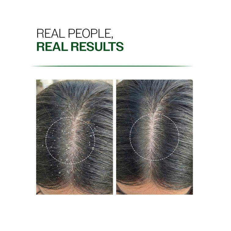Anti-Dandruff Shampoo (250ml ) & Dandruff Control Spray (200 ml) Combo