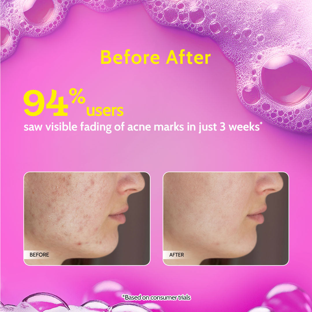 2% Salicylic Acid Face Wash for Acne & Oil Control - 100 ml | Pack of 2