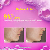 2% Salicylic Acid Face Wash for Acne & Oil Control - 100 ml | Pack of 2