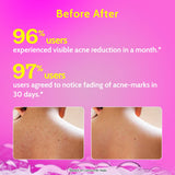 1% Salicylic Acid Body Wash for Acne Control - 236 ml