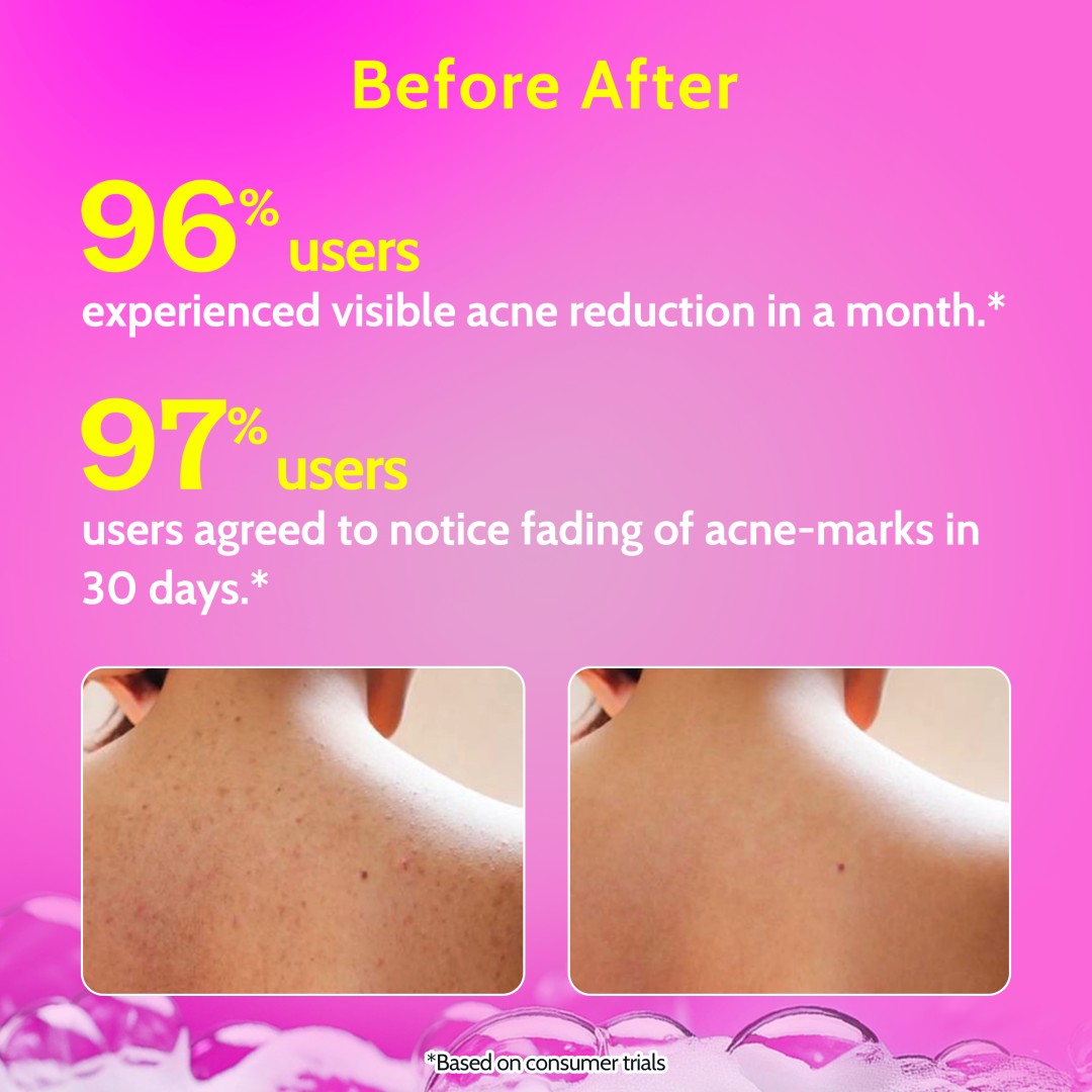 1% Salicylic Acid Body Wash for Acne Control - 473 ml