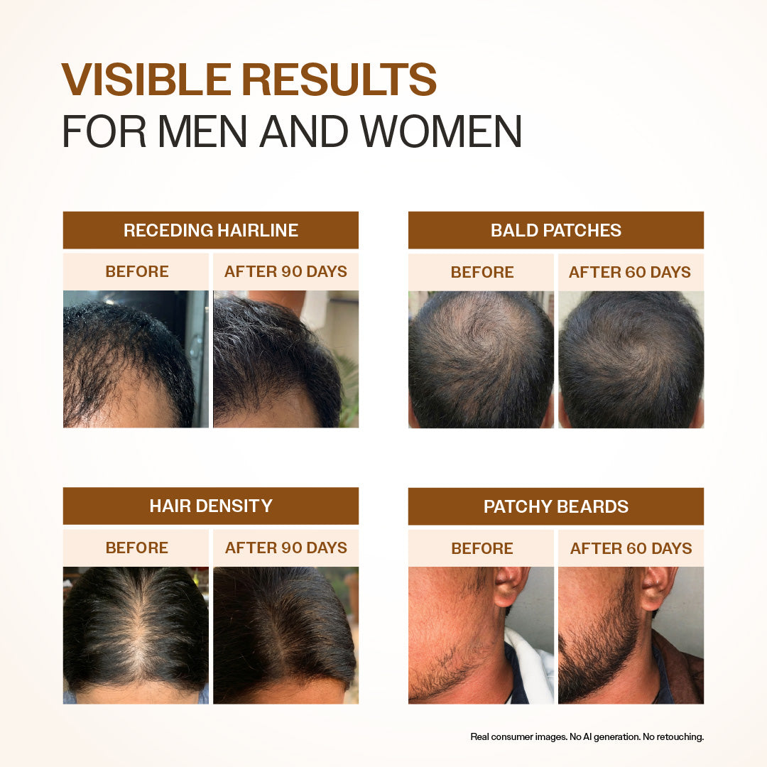 Advanced Hair Growth Serum with 3% Redensyl, 4% Anagain, 3% Bicapil & 1% Capilia Longa - 30 ml