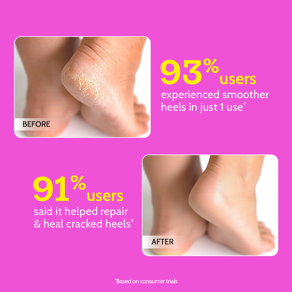 20% Urea Foot Roll-On for Cracked Heels & Diabetic Foot - 50 gm