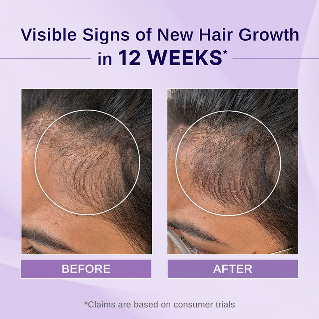 Rosemary & Hibiscus Hair Growth Oil - 100 ml | Pack of 2