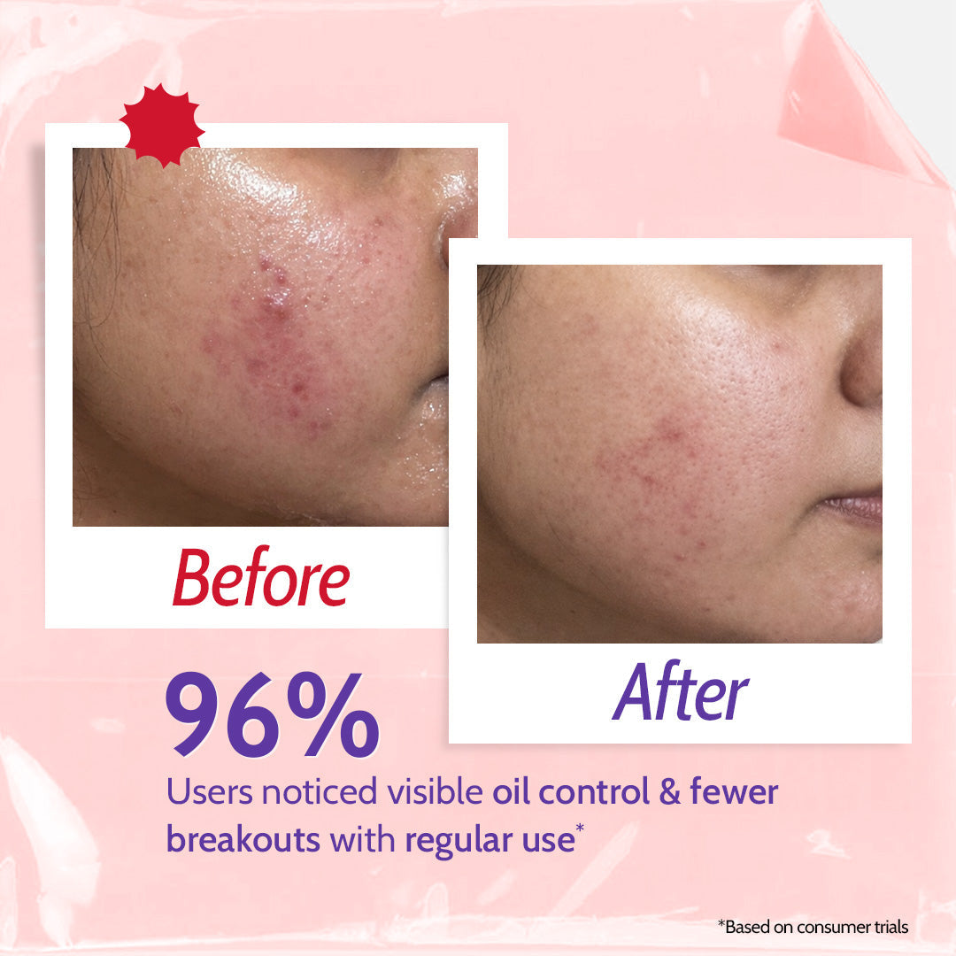 2% Salicylic Acid Face Wash for Acne & Oil Control - 100 ml