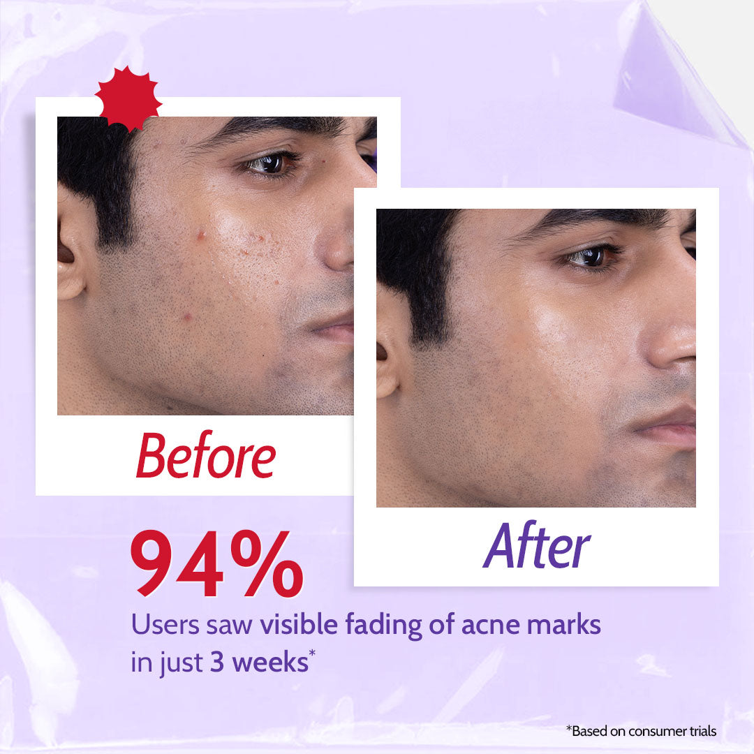 2% Salicylic Acid Face Wash for Acne & Oil Control - 100 ml