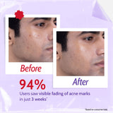 2% Salicylic Acid Face Wash for Acne & Oil Control - 100 ml