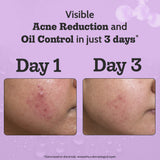 2% Salicylic Acid Face Serum for Acne Control - 10 ml