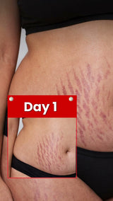 Pokonut Stretch Mark Cream